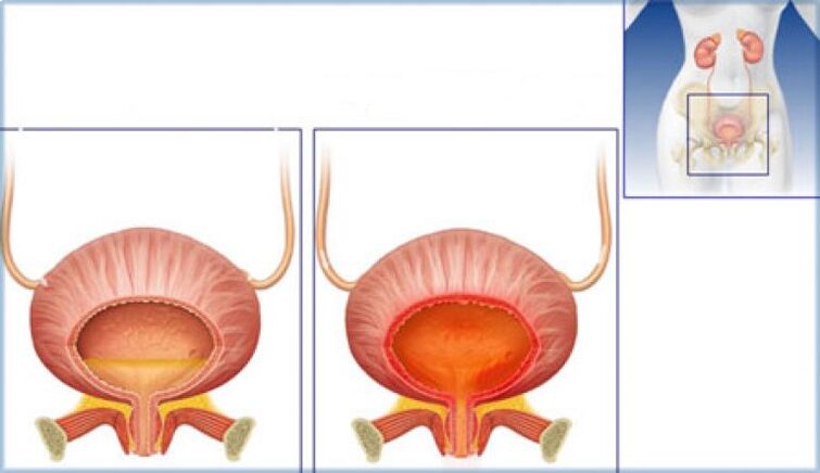 The bladder is normal and there are signs of inflammation due to cystitis